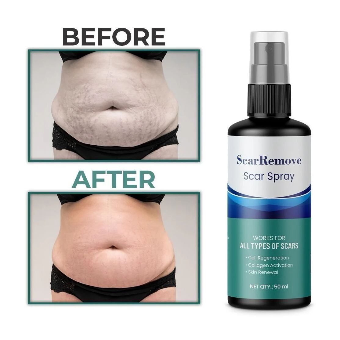 ScarRemove™ All Type Scar Removal Spray - Korean Made | BUY 1 GET 1 FREE |  ⭐️⭐️⭐️⭐️ 4.9/5 Reviews