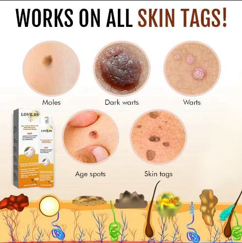 WartX™ Bee Venom Tags & Wart Treatment Spray | Buy 1 Get 1 Free