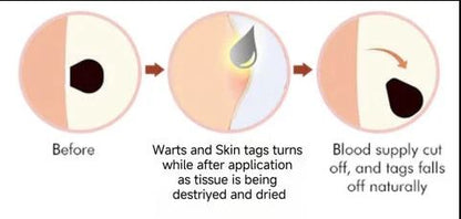 WartX™ Bee Venom Tags & Wart Treatment Spray | Buy 1 Get 1 Free