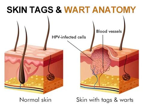 WartX™ Bee Venom Tags & Wart Treatment Spray | Buy 1 Get 1 Free